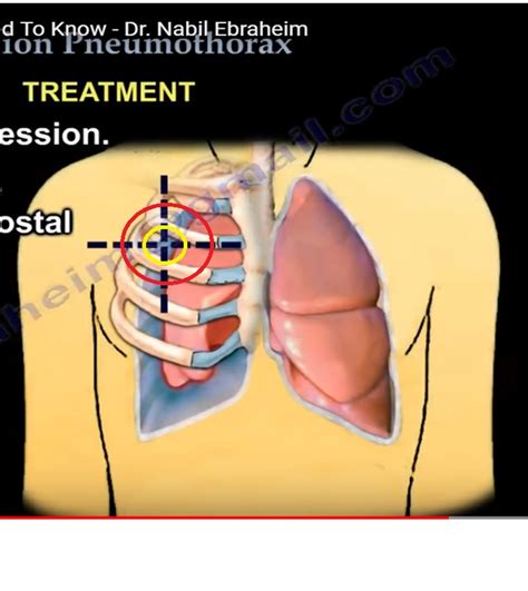 Tension Pneumothorax Orthopaedicprinciples