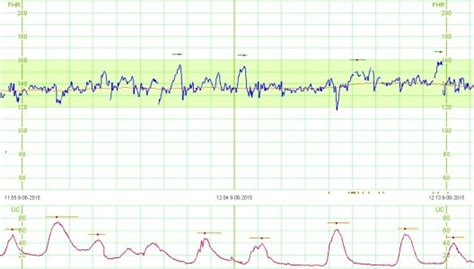 Cardiotocografia Anteparto Fetalmed Medicina Fetal Curitiba