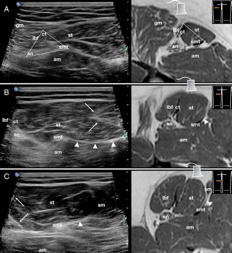 Ultrasound Features Of The Proximal Hamstring Muscle‐tendon‐bone Unit Becciolini 2019