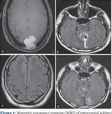 Figure From Intracranial Solitary Fibrous Tumor Hemangiopericytoma