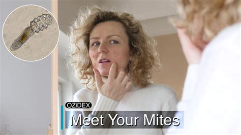 Acne Solution Demodex Mite Skin Treatment Procutin Ozidex