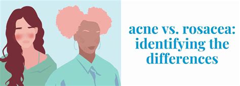 Acne Vs Rosacea Differences Causes And Symptoms Explained