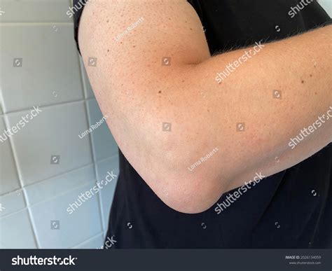 Olecranon Bursitis Sometimes Called Bursitis Swelling Stock Photo