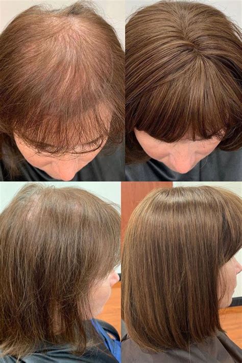 How To Cover Up Thinning Hair In Front Tips And Tricks The 2023 Guide