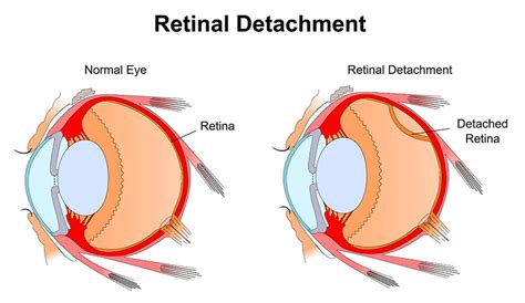 Retinal Detachment: Symptoms And Risk Factors - CTN News