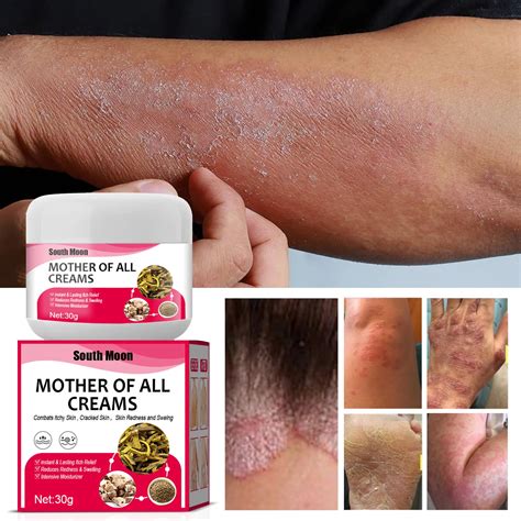 Hypersensitivity Topical External Skin Itching Herba Tinea Pedis Cream