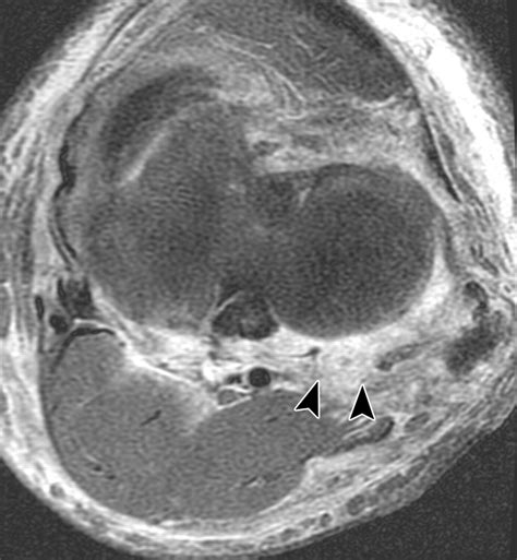 The Posterolateral Corner Of The Knee Ajr