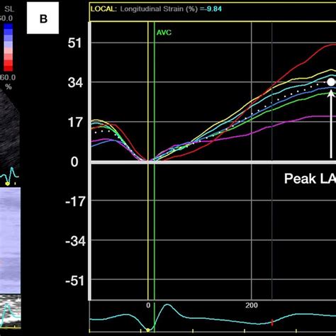 Measurement Of Left Atrial La Longitudinal Peak Systolic Strain