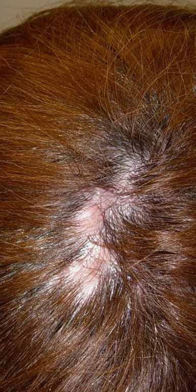 Follicular Lichen Planus