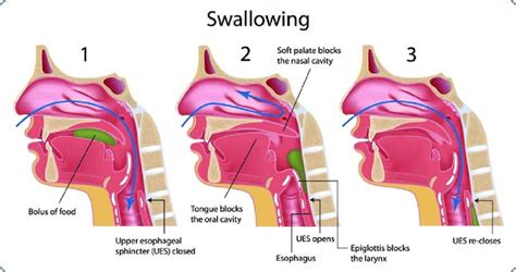 Dysphagia Types