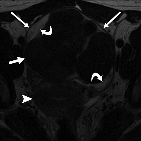 Mri Features Of Ovarian Fibroma And Fibrothecoma With Histopathologic