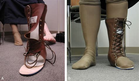 Pes Planus - Clinical Tree