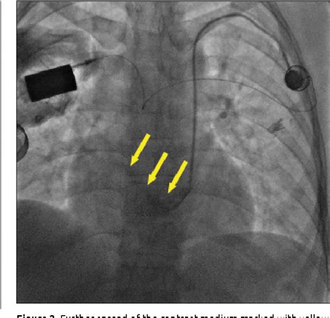 Figure 1 From Persistent Left Superior Vena Cava Incidentally Recognized Postoperatively After