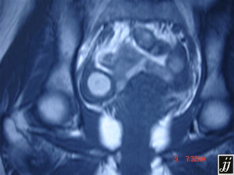 Right Ovary Chocolate Cyst Radiopaedia