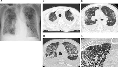 Pulmonary Lymphangitic Carcinomatosis From Gallbladder Cancer Mimicking Diffuse Alveolar