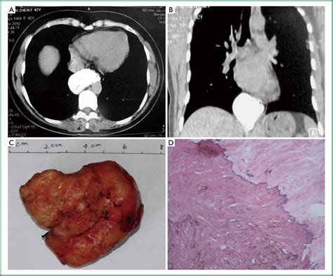 Figure 1 From Surgical Treatment Of Esophageal Leiomyoma Larger Than 5 Cm In Diameter A Case