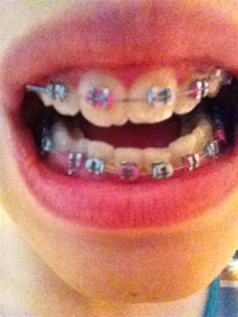 Screaming Pink And Light Blue So Cute Braces Colors Color