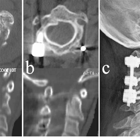 C2 Vertebral Body Fracture In A Young Lady Spinal Canal Narrowing Is