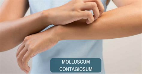 Molluscum Contagiosum Causes Symptoms Treatment And Off