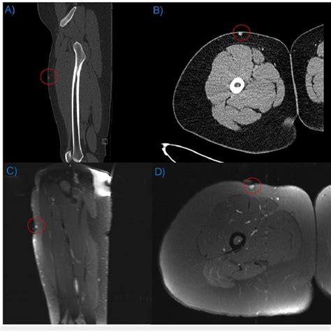 Pre Operative Ct And Mri Contrasted Ct And Mri Of The Right Lower Download Scientific Diagram