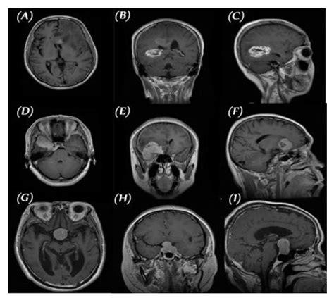 Diagnostics Free Full Text Classification Of Brain Mri Tumor Images