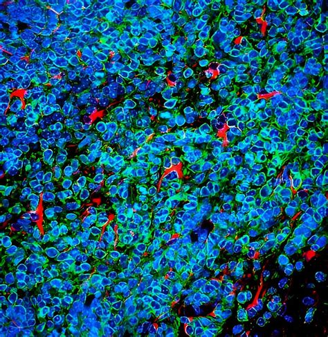 Lung Cancer Cells Covertly Thrive In Brain Under Guise Of Protection