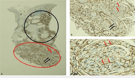 A Cluster Of Differentiation 34 Cd34 Staining Of A Traumatic Neuroma