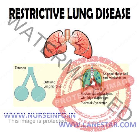 RESTRICTIVE LUNG DISEASES - Nurse Info