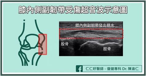 膝蓋韌帶受傷如何保養？復健科醫師親授「5招」在家就能做的復健法 蕃新聞