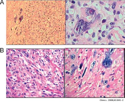 Pleomorphic Undifferentiated Sarcoma Of The Penis Clinics