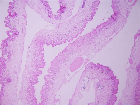 Isolated Intramuscular Cysticercosis Clinicopathological Features