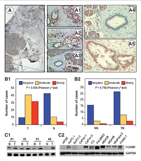 Figure 1 From Dysregulated Expression Of FOXM1 Isoforms Drives