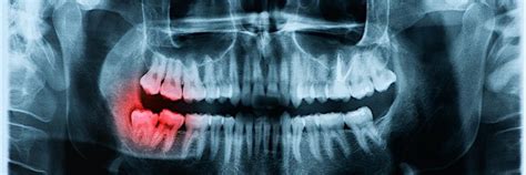 Warning Signs Of Impacted Wisdom Teeth Eagle Rock Dental Care