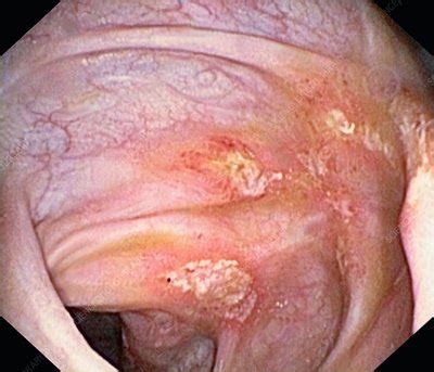 Crohn S Disease Stock Image C Science Photo Library