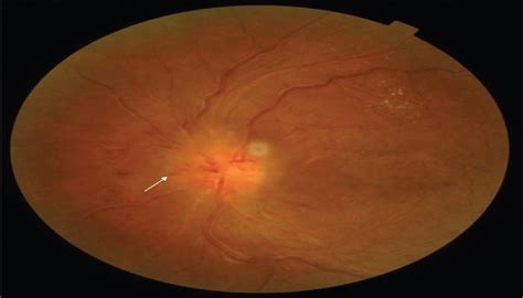 Unilateral buried optic nerve head drusen triggering central... : Oman Journal of Ophthalmology