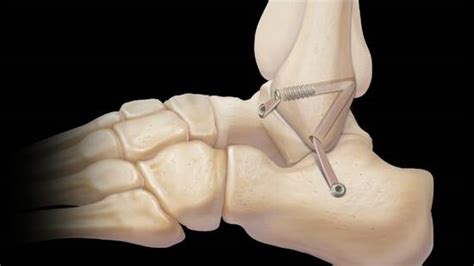 Lateral Ankle Ligament Injuries Allograft Reconstruction Of Lateral