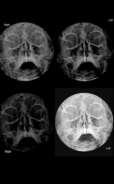 PNS x-ray.Sinus issues. Need inputs. How to find if I have sinus from the x-ray?please ...