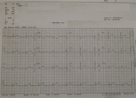 Posterior MI Recognition - emdocs