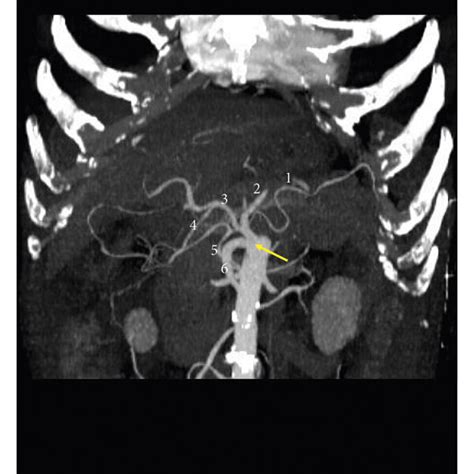 Three Dimensional Volume Rendering Ct Image Showing A Complete Cmt