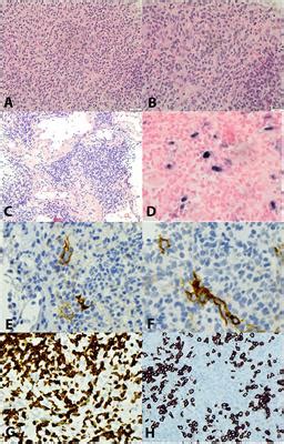 Frontiers Case Report Identification Of A Novel Stat Mutation In