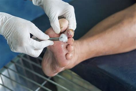 Ways Of Treating Foot And Toe Ulcers