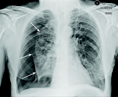 Large Right Sided Secondary Pneumothorax In Patient With Severe Chronic