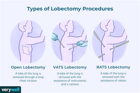 Lobectomy Complications and Prognosis