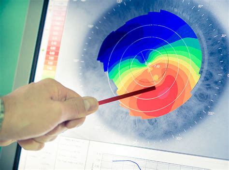 Our Technology California Lasik Eye