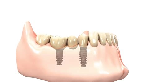 Implantes Dentales de Carga Inmediata en Barcelona CEID Clínicas Dentales