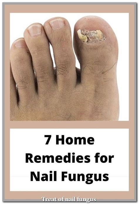 Anti Fungal Treatment Kill Toenail Fungus By Homemade Solution Artofit