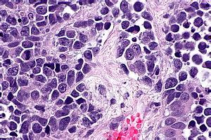 Small Cell Carcinoma Of The Urinary Bladder Libre Pathology