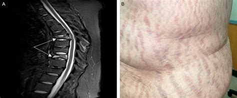 Clinical Images Vertebral Compression Fractures And Striae In Cushing