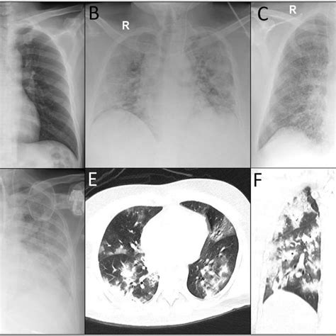 COVID 19 Patients Chest Imaging A Normal Chest Radiography Of A