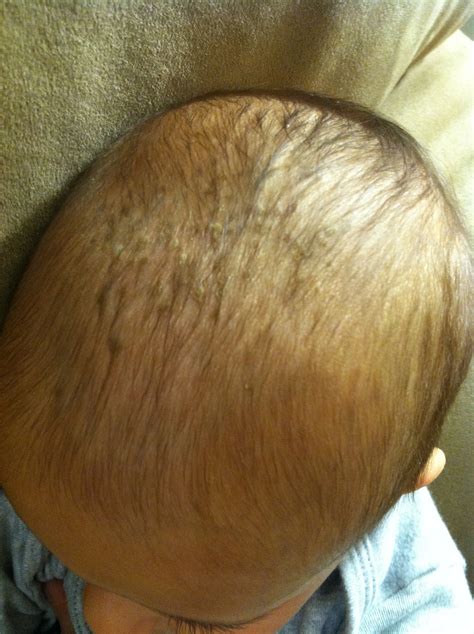 goodbye cradle cap